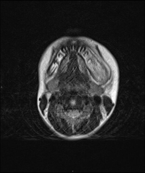 File:Chronic reactive multifocal osteomyelitis (CRMO) - mandible (Radiopaedia 56405-63069 Axial T2 7).jpg