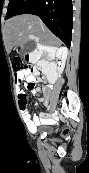 File:Chronic small bowel volvulus (Radiopaedia 75224-86322 C 94).jpg