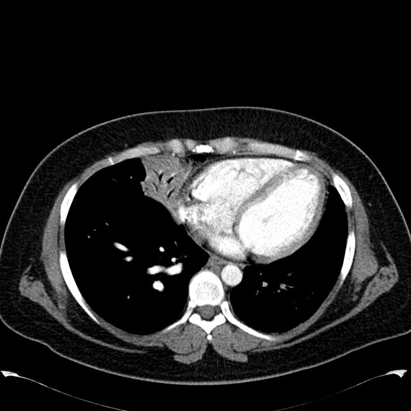 File:Chronic thromboembolic pulmonary hypertension (CTEPH) (Radiopaedia 74597-85531 Axial C+ CTPA 34).jpg
