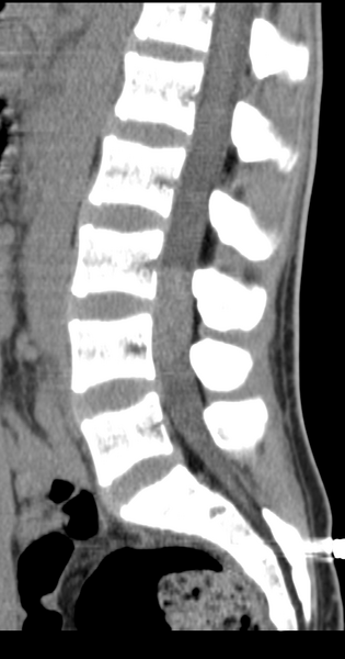 File:Clear cell meningoma - lumbar spine (Radiopaedia 60116-67691 A 22).png