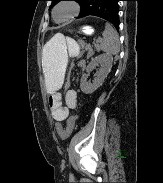 File:Closed-loop small bowel obstruction-internal hernia (Radiopaedia 78439-91096 C 45).jpg