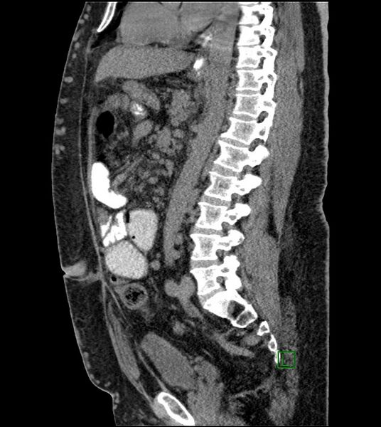 File:Closed-loop small bowel obstruction-internal hernia (Radiopaedia 78439-91096 C 71).jpg