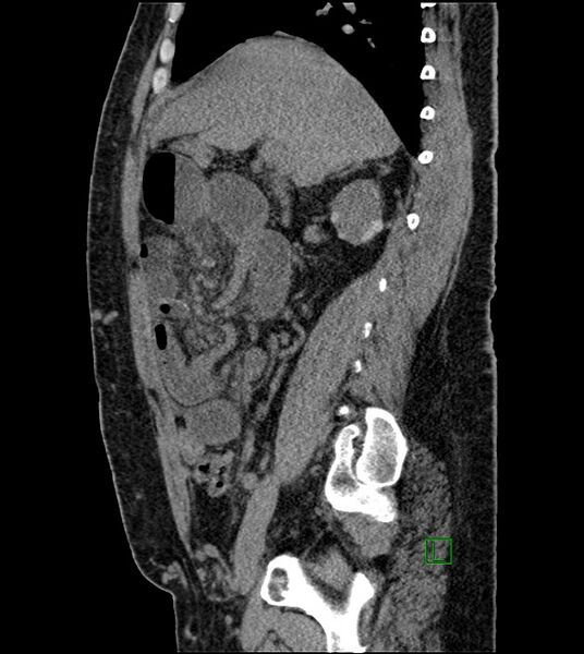 File:Closed-loop small bowel obstruction-internal hernia (Radiopaedia 78439-91096 C 93).jpg