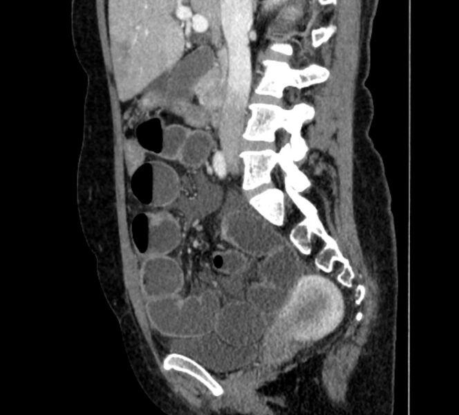 File:Closed loop small bowel obstruction (Radiopaedia 71211-81508 C 60).jpg