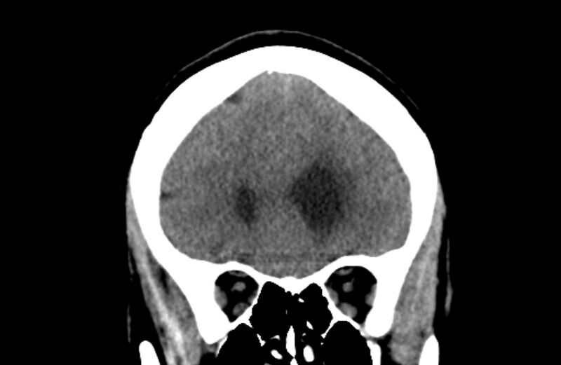 File:Colloid cyst (Radiopaedia 53180-59146 Coronal non-contrast 18).jpg