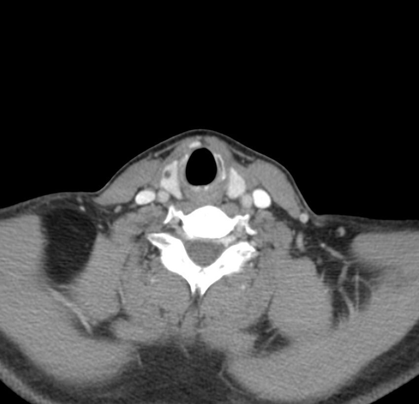 Colloid cyst of thyroid (Radiopaedia 22897-22923 Axial C+ delayed 56).jpg