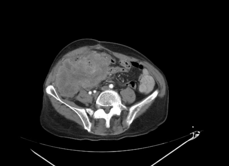 File:Colon cancer mimicking renal cell carcinoma (Radiopaedia 28986-29335 B 52).jpg