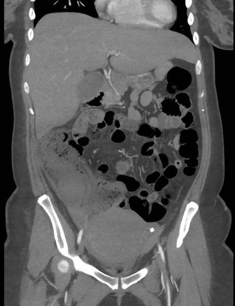 File:Colonic pseudo-obstruction (Radiopaedia 79752-92980 B 28).png