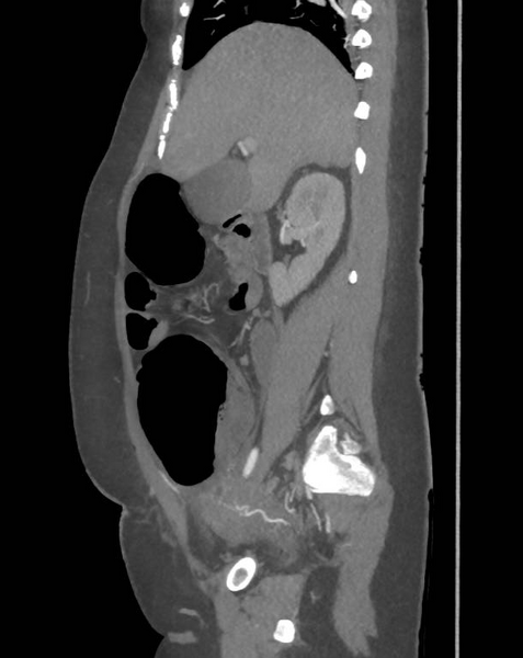 File:Colonic pseudo-obstruction (Radiopaedia 79752-92980 C 30).png
