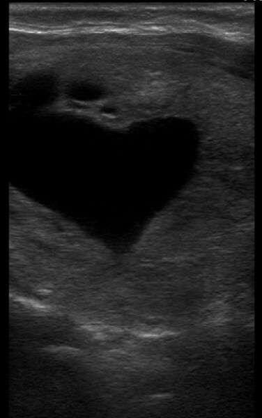 File:Heart-shaped thyroid cyst (Radiopaedia 72459).jpg