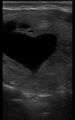 Heart-shaped thyroid cyst (Radiopaedia 72459).jpg