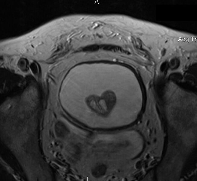 File:Heart appearance of benign prostate hyperplasia (Rorschach radiology) (Radiopaedia 52699).jpg