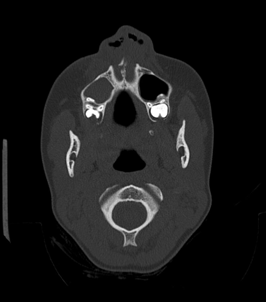 Nasoorbitoethmoid fracture (Radiopaedia 90044-107205 Axial bone window 51).jpg