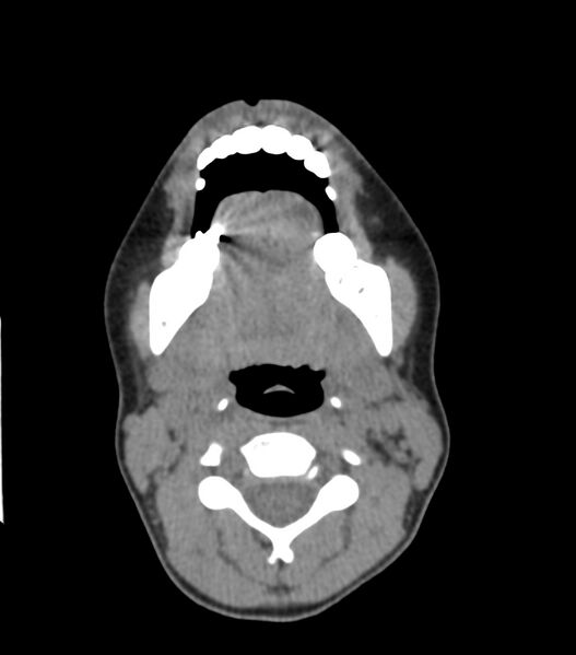 File:Nasoorbitoethmoid fracture (Radiopaedia 90044-107205 Axial non-contrast 68).jpg