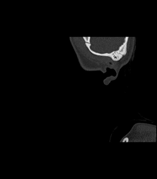 File:Nasoorbitoethmoid fracture (Radiopaedia 90044-107205 Sagittal bone window 8).jpg