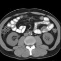 Necrotizing pancreatitis with acute necrotic collection (Radiopaedia 14470-14417 Axial non-contrast 26).jpg