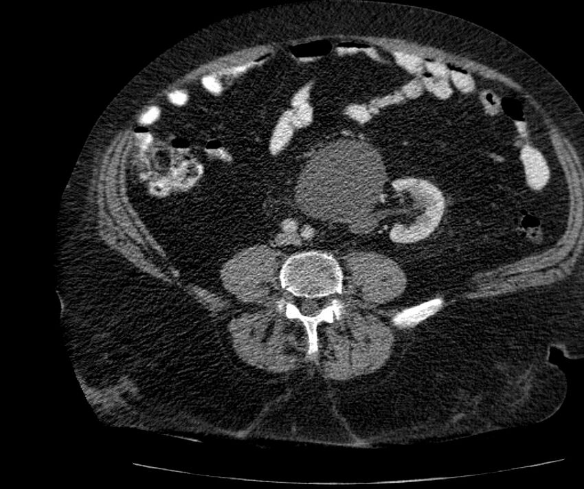 Nephroptosis with inguinal hernia containing perirenal fat (Radiopaedia 56632-63391 C 216).jpg