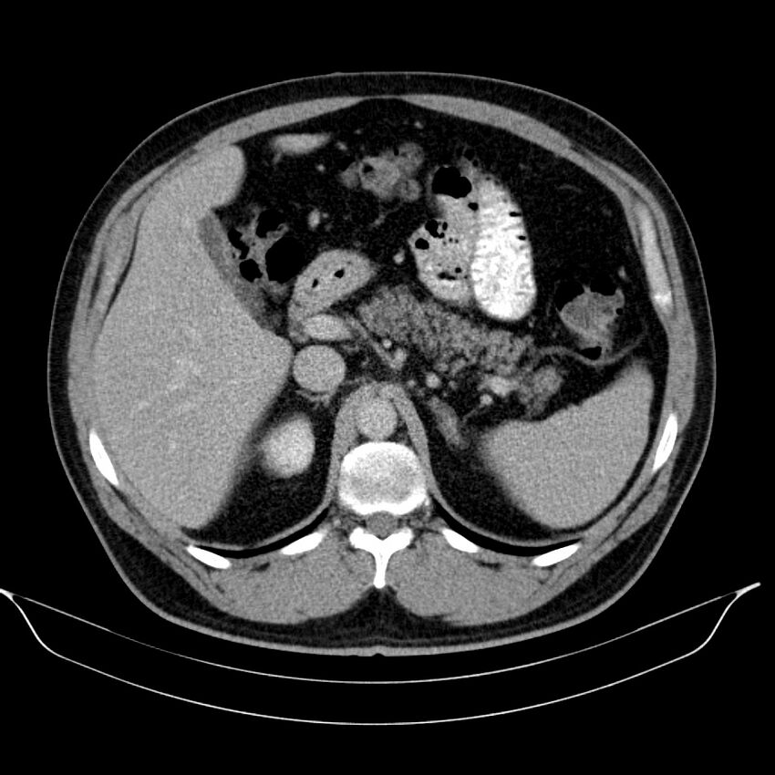 Neuroendocrine tumor of head of pancreas (Radiopaedia 57538-64502 D 26).jpg