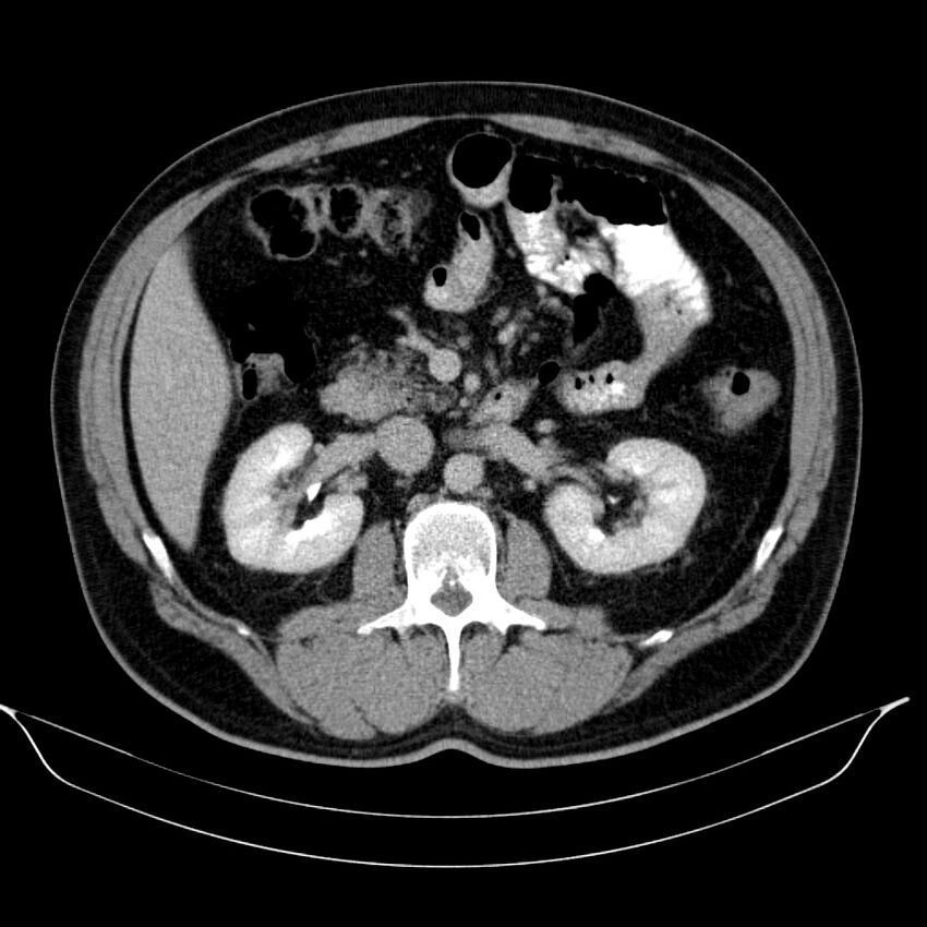 Neuroendocrine tumor of head of pancreas (Radiopaedia 57538-64502 D 36).jpg