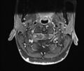 Neurofibromatosis type 1 (Radiopaedia 80355-93740 Axial T1 C+ fat sat 4).jpg