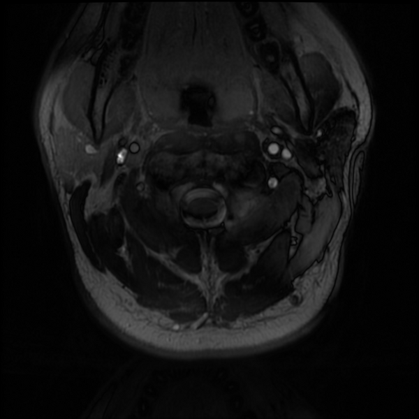 File:Neurofibromatosis type 2 (Radiopaedia 44936-48837 Axial Gradient Echo 42).png