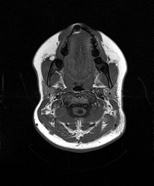 File:Neurofibromatosis type 2 (Radiopaedia 66211-75401 Axial T1 3).jpg