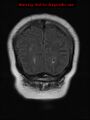 Neuroglial cyst (Radiopaedia 10713-11184 Coronal FLAIR 5).jpg