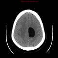 Neuroglial cyst (Radiopaedia 10713-11185 Axial non-contrast 10).jpg