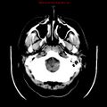 Neuroglial cyst (Radiopaedia 10713-11185 Axial non-contrast 29).jpg