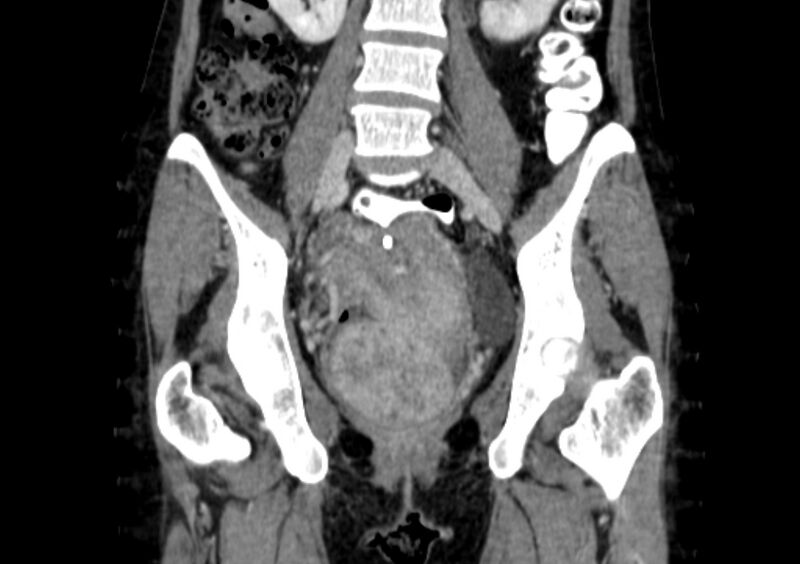 File:Non-puerperal uterine inversion (Radiopaedia 78343-91094 B 15).jpg