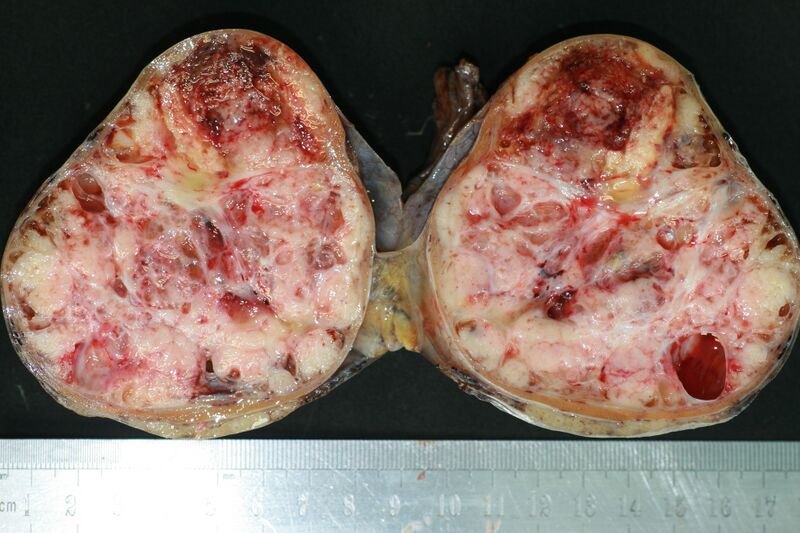 File:Non-seminomatous germ cell tumor - testis (gross pathology) (Radiopaedia 26745-26906 Gross pathology 1).JPG