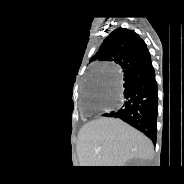 File:Non hodgkin lymphoma of the mediastinum (Radiopaedia 20814-20729 D 15).jpg