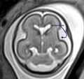 Normal brain fetal MRI - 22 weeks (Radiopaedia 50623-56604 Sulcation 1).jpg