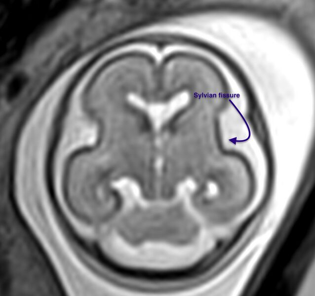 File:Normal brain fetal MRI - 22 weeks (Radiopaedia 50623-56604 Sulcation 1).jpg