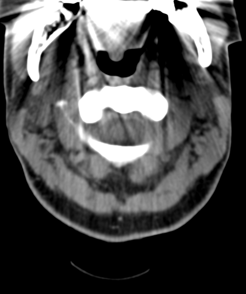File:Normal cervical spine MRI (including Dixon) (Radiopaedia 42762-45926 Axial non-contrast 14).png