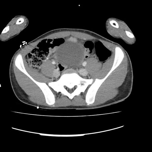 File:Normal dual-phase trauma CT chest,abdomen and pelvis (Radiopaedia 48092-52899 A 91).jpg