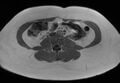 Normal liver MRI with Gadolinium (Radiopaedia 58913-66163 Axial T1 in-phase 1).jpg