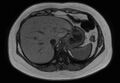 Normal liver MRI with Gadolinium (Radiopaedia 58913-66163 B 25).jpg