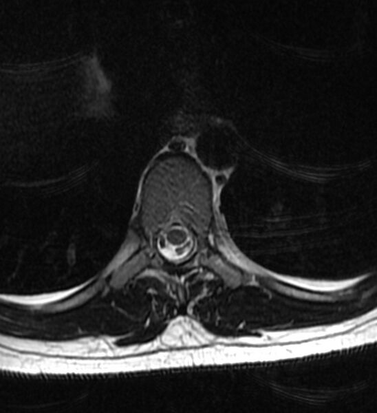 File:Normal thoracic spine MRI (Radiopaedia 41033-43781 Axial T2 10).jpg