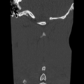 Normal trauma cervical spine (Radiopaedia 41017-43760 Coronal bone window 39).png
