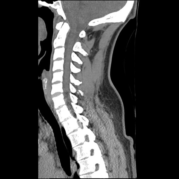 File:Normal trauma spine imaging (Radiopaedia 31753-32686 A 18).jpg