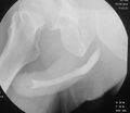 Normal urethra (Radiopaedia 30340-30985 oblique 1).JPG