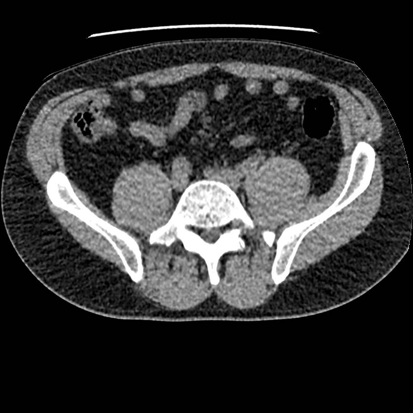 Obstructing ureteric calculus and ureteric anatomy (Radiopaedia 62730-71042 Axial non-contrast 102).jpg