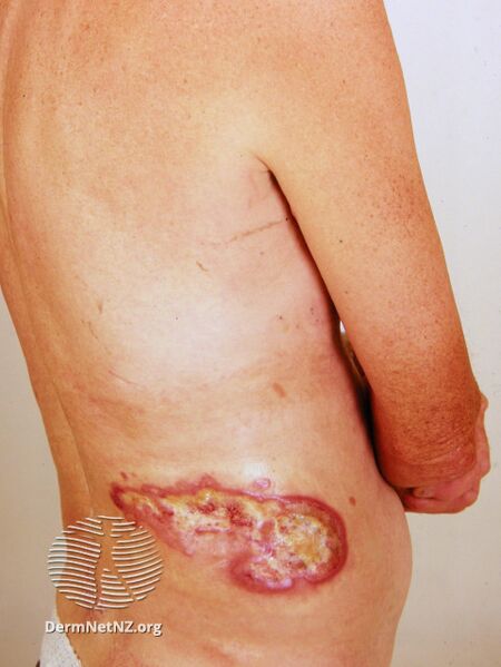 File:Ulcerated tumour stage mycosis fungoides (DermNet NZ mycosis-fungoides-16).jpg