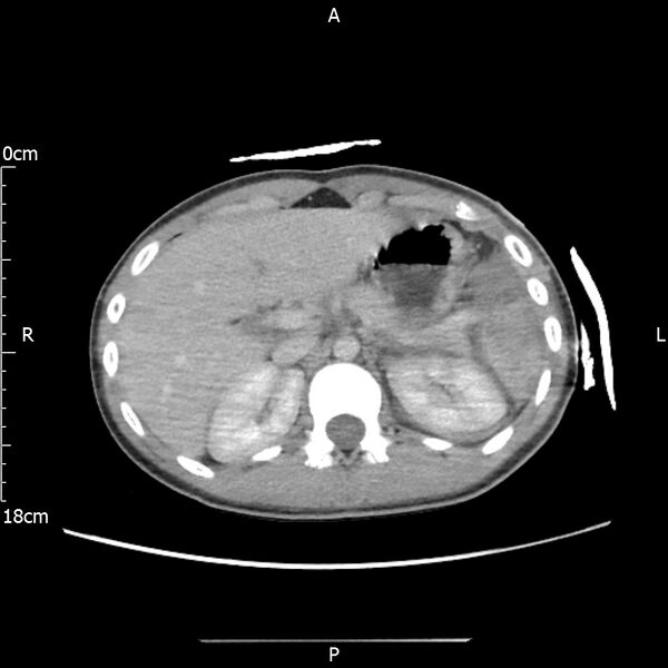 File:AAST grade IV kidney injury with CEUS follow-up (Radiopaedia 72353-82877 Axial C+ portal venous phase 18).jpg
