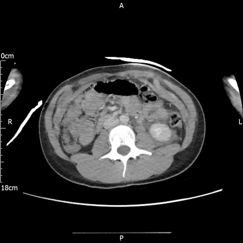 AAST grade IV kidney injury with CEUS follow-up (Radiopaedia 72353-82877 Axial C+ portal venous phase 34).jpg