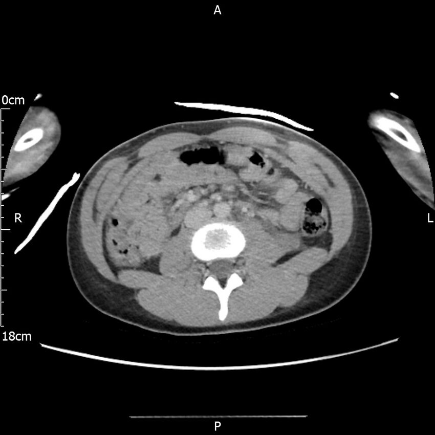 AAST grade IV kidney injury with CEUS follow-up (Radiopaedia 72353-82877 Axial C+ portal venous phase 37).jpg