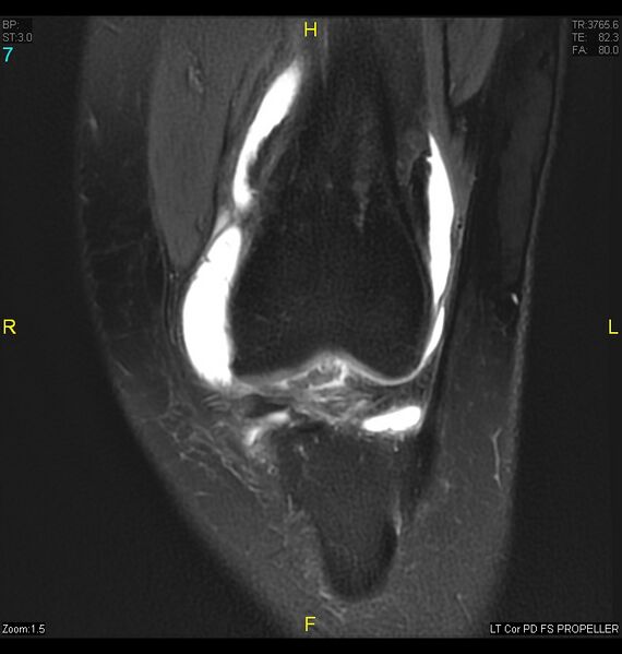 File:ACL mucoid degeration with cystic changes (Radiopaedia 48428-53341 Coronal PD fat sat 4).jpg