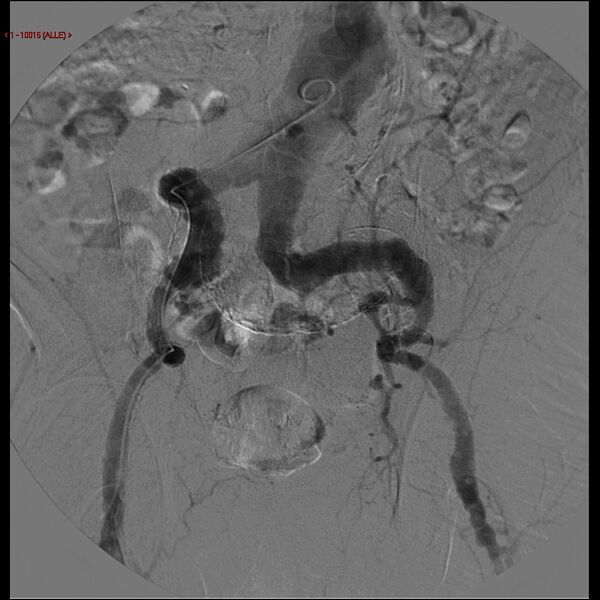 File:Abdominal aortic aneurysm (Radiopaedia 16155-15833 Frontal Aorta 11).jpg