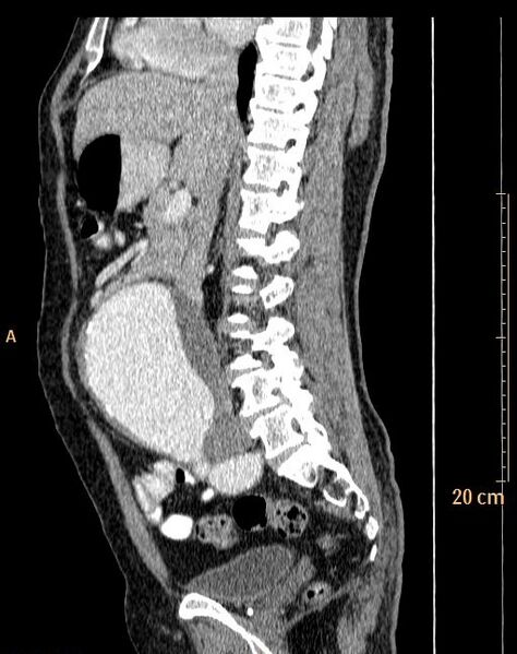 File:Abdominal aortic aneurysm (Radiopaedia 25985-26121 Sagittal C+ arterial phase 23).jpg